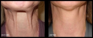 before-after-fibroblast.jpg